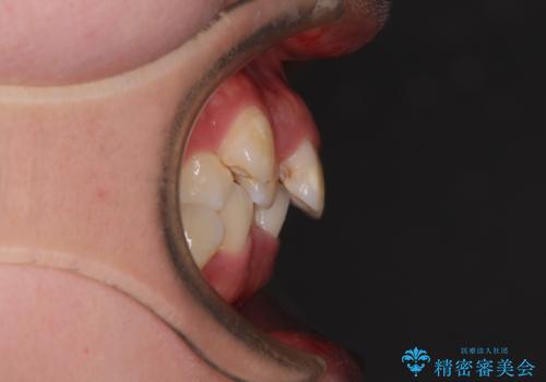【モニター】八重歯を抜歯矯正でスッキリした口元にの治療前