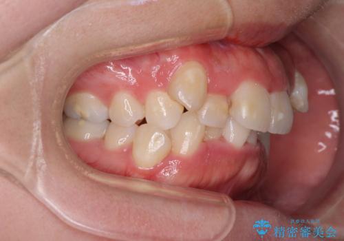 【モニター】八重歯を抜歯矯正でスッキリした口元にの治療前