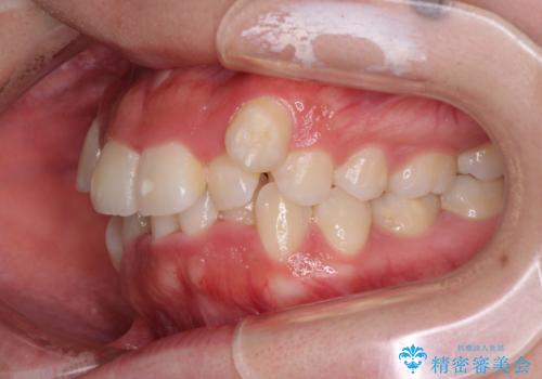 【モニター】八重歯を抜歯矯正でスッキリした口元にの治療前