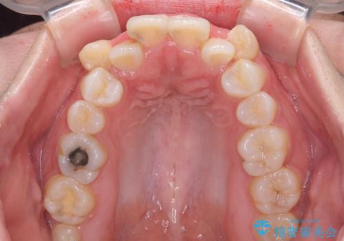 【モニター】八重歯を抜歯矯正でスッキリした口元にの治療前
