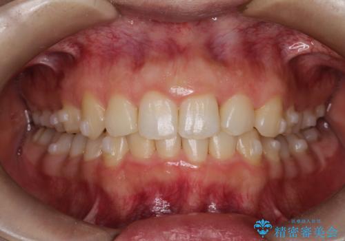 押しつぶされた歯列、アーチの拡大だけで非抜歯で改善した症例の治療中