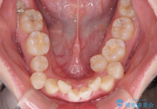 【モニター】八重歯を抜歯矯正でスッキリした口元にの治療前