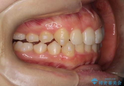 押しつぶされた歯列、アーチの拡大だけで非抜歯で改善した症例の治療中