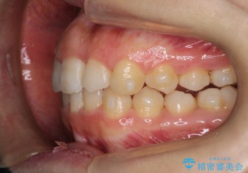 押しつぶされた歯列、アーチの拡大だけで非抜歯で改善した症例の治療中