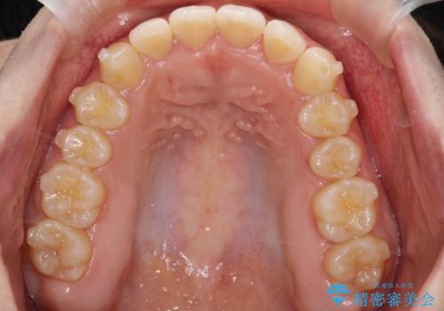 押しつぶされた歯列、アーチの拡大だけで非抜歯で改善した症例の治療中