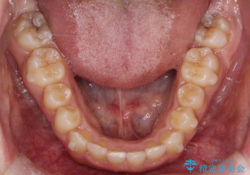 押しつぶされた歯列、アーチの拡大だけで非抜歯で改善した症例の治療中