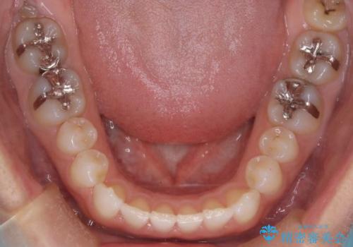 長い間コンプレックスだった前歯のすき間! 短期間終了。部分矯正症例 (インビザライン矯正) の治療後