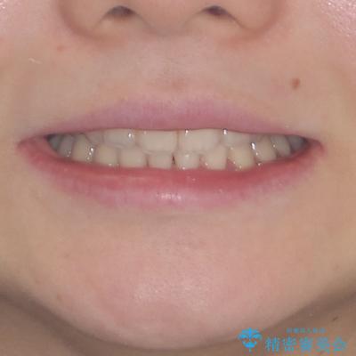 上顎のみの抜歯矯正　前歯のデコボコを改善するの治療後（顔貌）