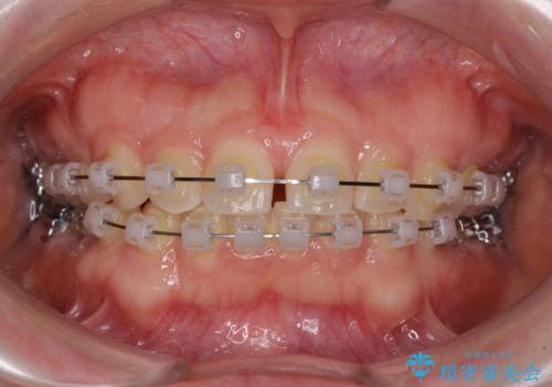 【モニター】前歯の歯列不正をワイヤー装置で短期間矯正治療の治療中