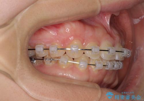 【モニター】前歯の歯列不正をワイヤー装置で短期間矯正治療の治療中
