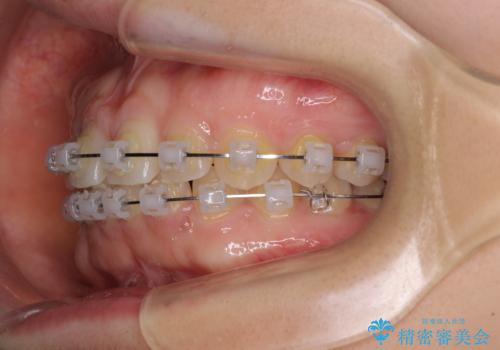 【モニター】前歯の歯列不正をワイヤー装置で短期間矯正治療の治療中