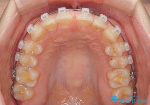 【モニター】前歯の歯列不正をワイヤー装置で短期間矯正治療の治療中