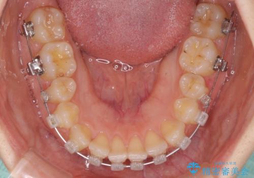 【モニター】前歯の歯列不正をワイヤー装置で短期間矯正治療の治療中