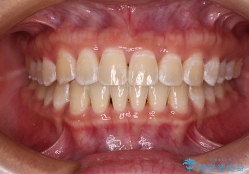 前歯の隙間と上下正中のズレを解消の症例 治療後