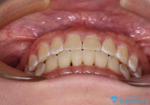 前歯の隙間と上下正中のズレを解消の治療後