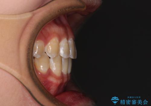 前歯の隙間と上下正中のズレを解消の治療後