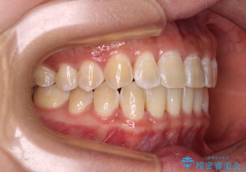 前歯の隙間と上下正中のズレを解消の治療後
