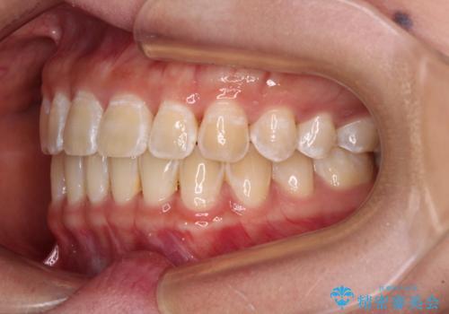 前歯の隙間と上下正中のズレを解消の治療後