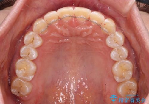 前歯の隙間と上下正中のズレを解消の治療後