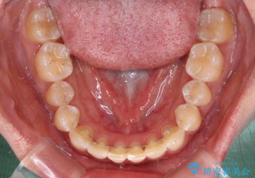 前歯の隙間と上下正中のズレを解消の治療後