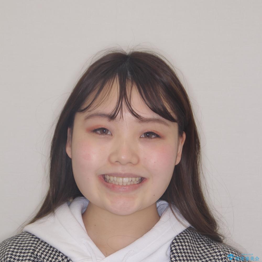 【モニター】ワイヤー矯正で手っ取り早く治療の治療後(顔貌)