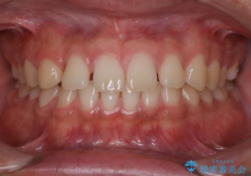 すきっ歯が気になる:見た目も噛み合わせもインビザラインでまとめて治すの症例 治療前