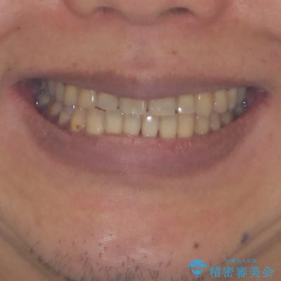 前歯のクロスバイトを改善　ワイヤー装置での非抜歯矯正の治療後（顔貌）
