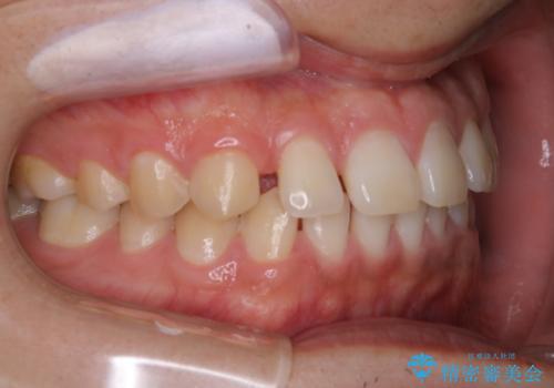 すきっ歯が気になる:見た目も噛み合わせもインビザラインでまとめて治すの治療前
