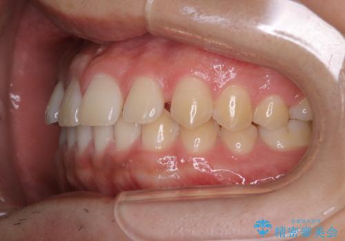 すきっ歯が気になる:見た目も噛み合わせもインビザラインでまとめて治すの治療前