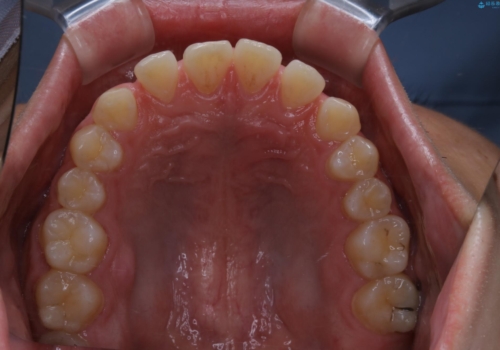 すきっ歯が気になる:見た目も噛み合わせもインビザラインでまとめて治すの治療前