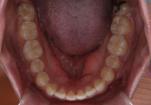 すきっ歯が気になる:見た目も噛み合わせもインビザラインでまとめて治すの治療前