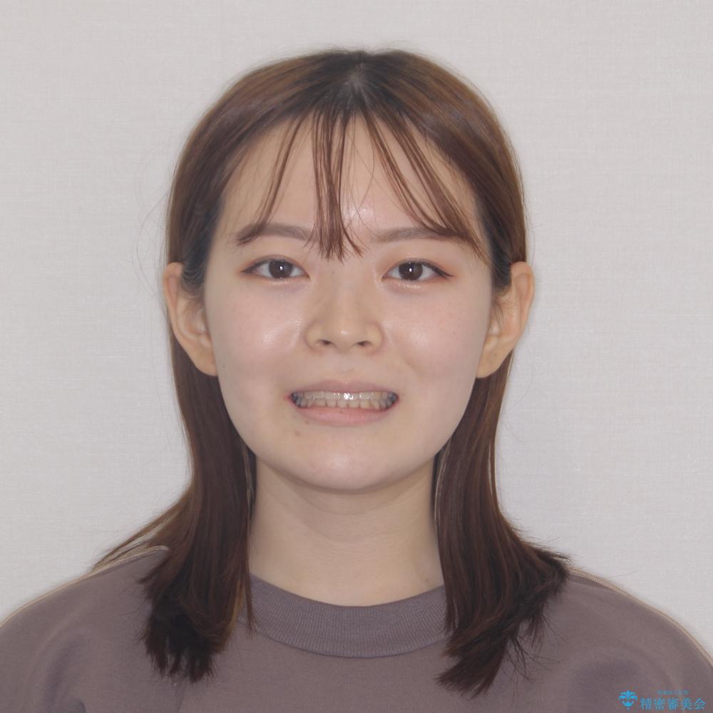【モニター】前歯のデコボコを目立たないワイヤー装置で短期間矯正治療の治療後(顔貌)