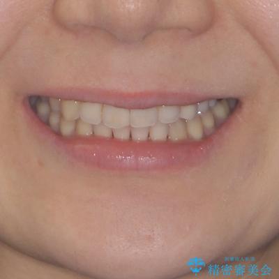 捻れた前歯と銀歯のブリッジを治したい ワイヤー矯正とオールセラミックブリッジの治療後(顔貌)