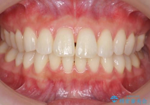 昔ワイヤー矯正をして後戻りした 軽度のがたつき モニター矯正の治療中