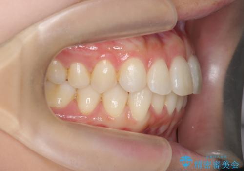 昔ワイヤー矯正をして後戻りした 軽度のがたつき モニター矯正の治療中