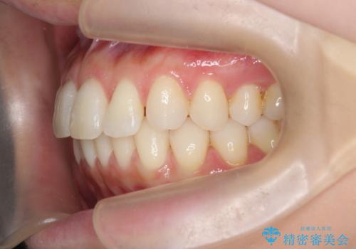 昔ワイヤー矯正をして後戻りした 軽度のがたつき モニター矯正の治療中