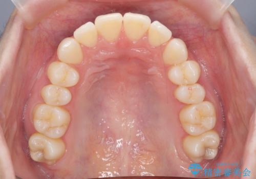 昔ワイヤー矯正をして後戻りした 軽度のがたつき モニター矯正の治療中
