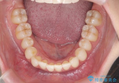 昔ワイヤー矯正をして後戻りした 軽度のがたつき モニター矯正の治療中