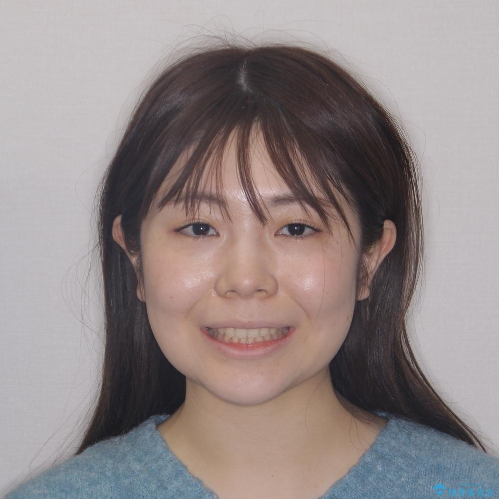 【モニター】前歯の歯列不正をワイヤー装置で短期間矯正治療の治療後(顔貌)
