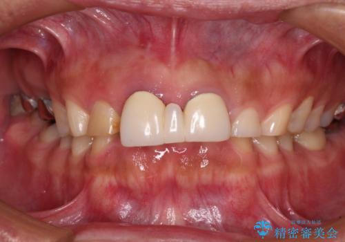不自然な前歯　歯肉移植を用いた前歯のオールセラミックブリッジの治療前
