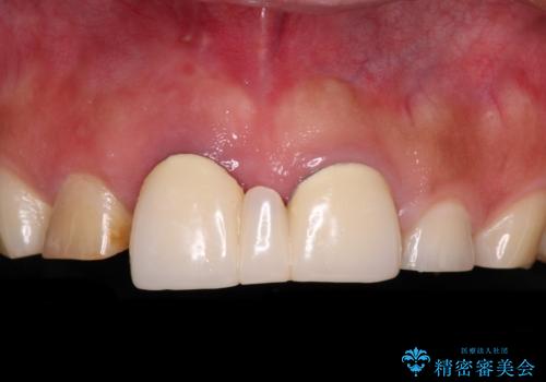 不自然な前歯　歯肉移植を用いた前歯のオールセラミックブリッジの症例 治療前