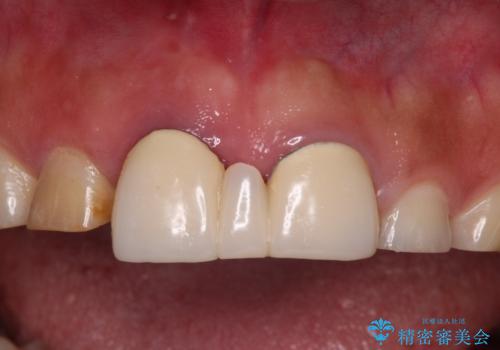 不自然な前歯 歯肉移植を用いた前歯のオールセラミックブリッジの治療前