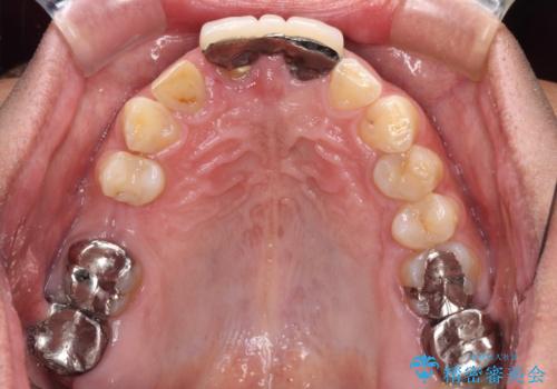 不自然な前歯 歯肉移植を用いた前歯のオールセラミックブリッジの治療前