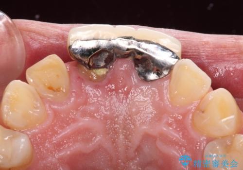 不自然な前歯 歯肉移植を用いた前歯のオールセラミックブリッジの治療前