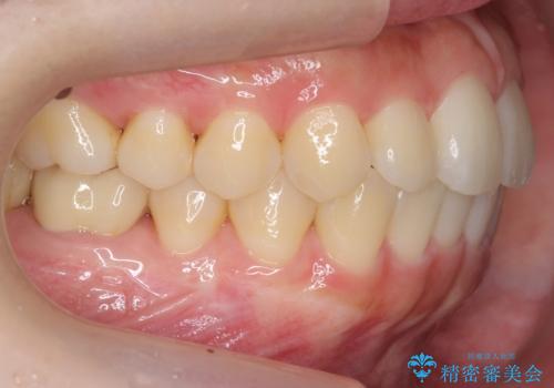 インビザライン モニターで前歯をきれいにの治療後