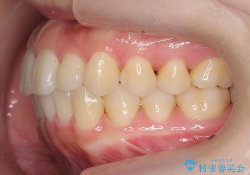 インビザライン モニターで前歯をきれいにの治療後