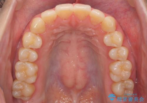 インビザライン モニターで前歯をきれいにの治療後