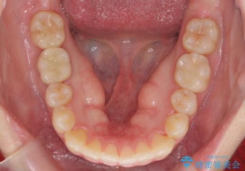 インビザライン モニターで前歯をきれいにの治療後