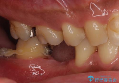 昔治療した銀歯を綺麗なセラミックに変えたい セラミックインレーの治療前