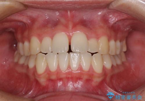すきっ歯とオープンバイトをインビザラインで改善の症例 治療前